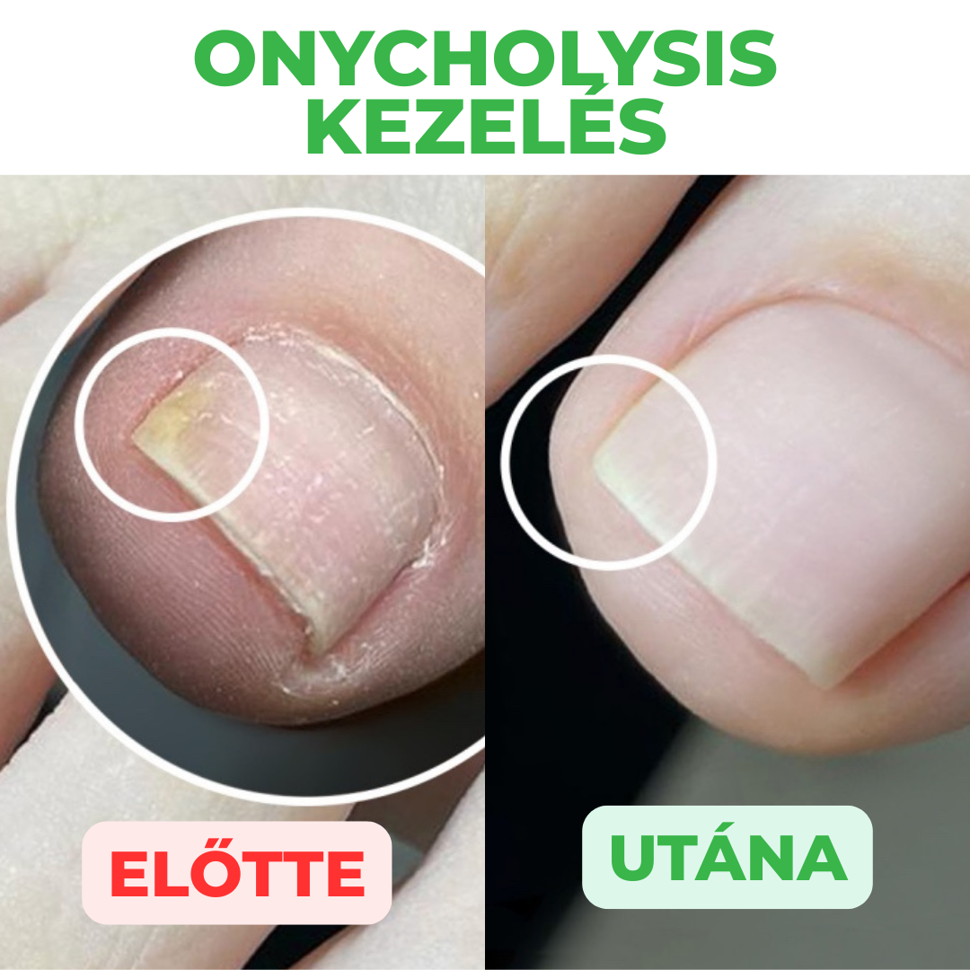 Aktív megoldás köröm és a bőr kezelésére, 30 ml