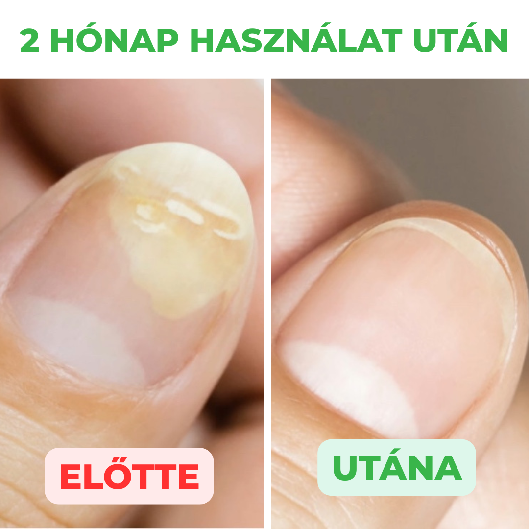 Aktív megoldás köröm és a bőr kezelésére, 30 ml
