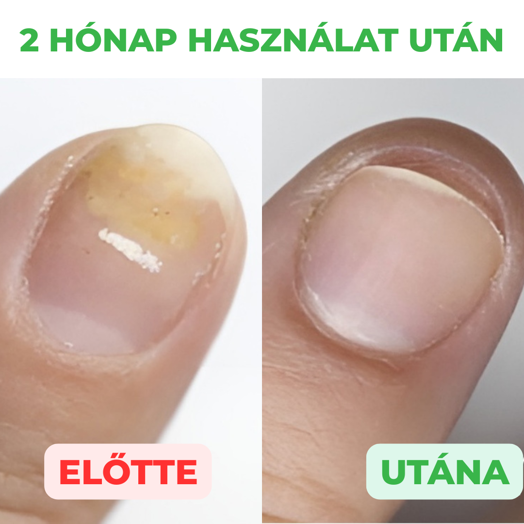 Aktív megoldás köröm és a bőr kezelésére, 30 ml